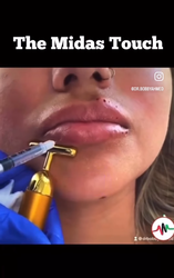 Lip Fillers in Liverpool, UK