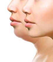 Chin fat dissolving injections Liverpool
